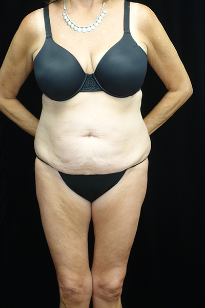 Tummy Tuck Before & After Patient #19541