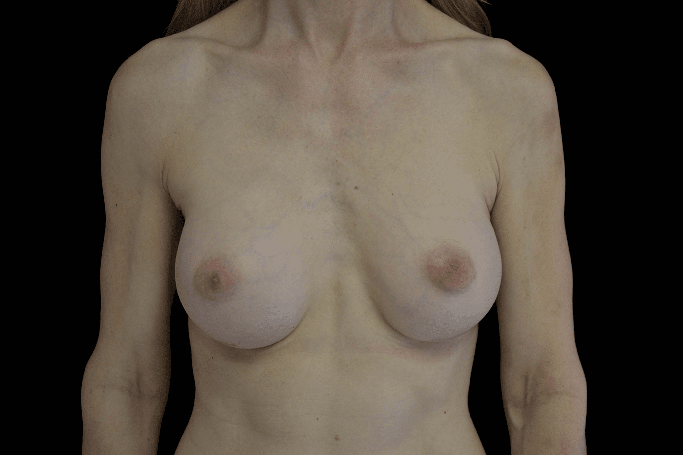 Breast Augmentation (Implants) Before & After Patient #19601
