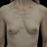 Breast Augmentation (Implants) Before & After Patient #19601