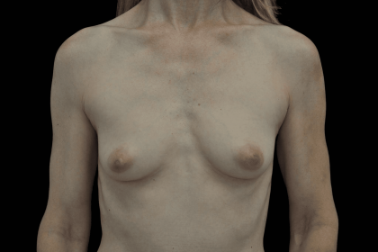 Breast Augmentation (Implants) Before & After Patient #19601