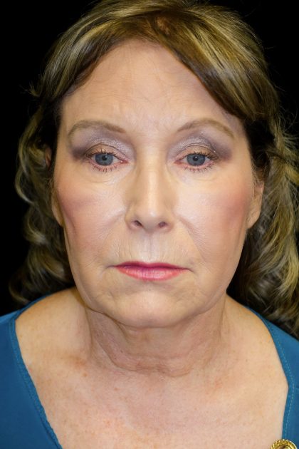 Facelift Before & After Patient #19592