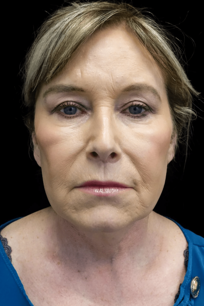 Facelift Before & After Patient #19592