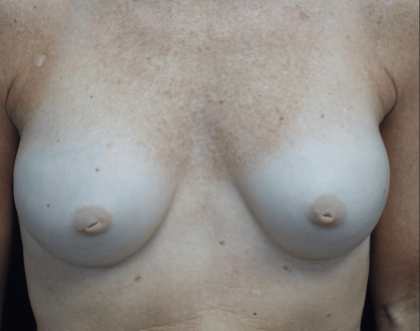 Nipple Inversion Before & After Patient #19740