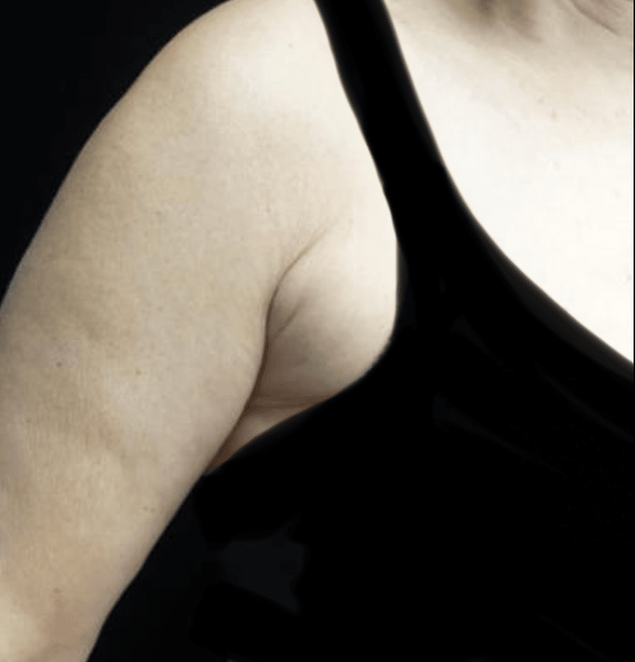 CoolSculpting Before & After Patient #19755
