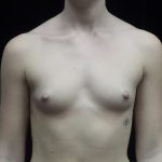 Breast Augmentation (Implants) Before & After Patient #19654