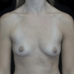Breast Augmentation (Implants) Before & After Patient #19773