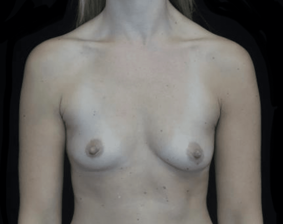 Breast Augmentation (Implants) Before & After Patient #19773