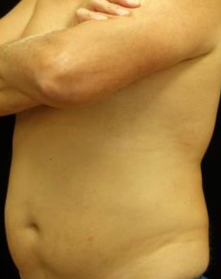 CoolSculpting Before & After Patient #19661