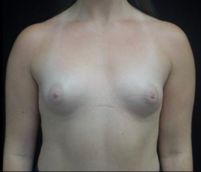 Breast Augmentation (Implants) Before & After Patient #19669