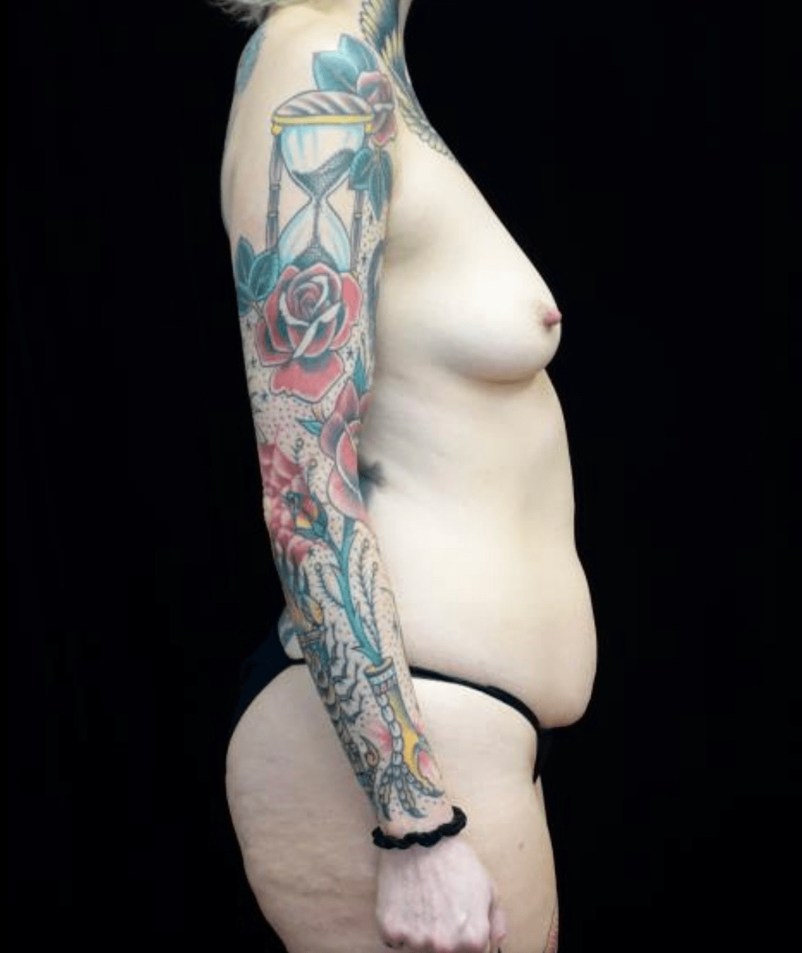 Breast Augmentation (Implants) Before & After Patient #19687