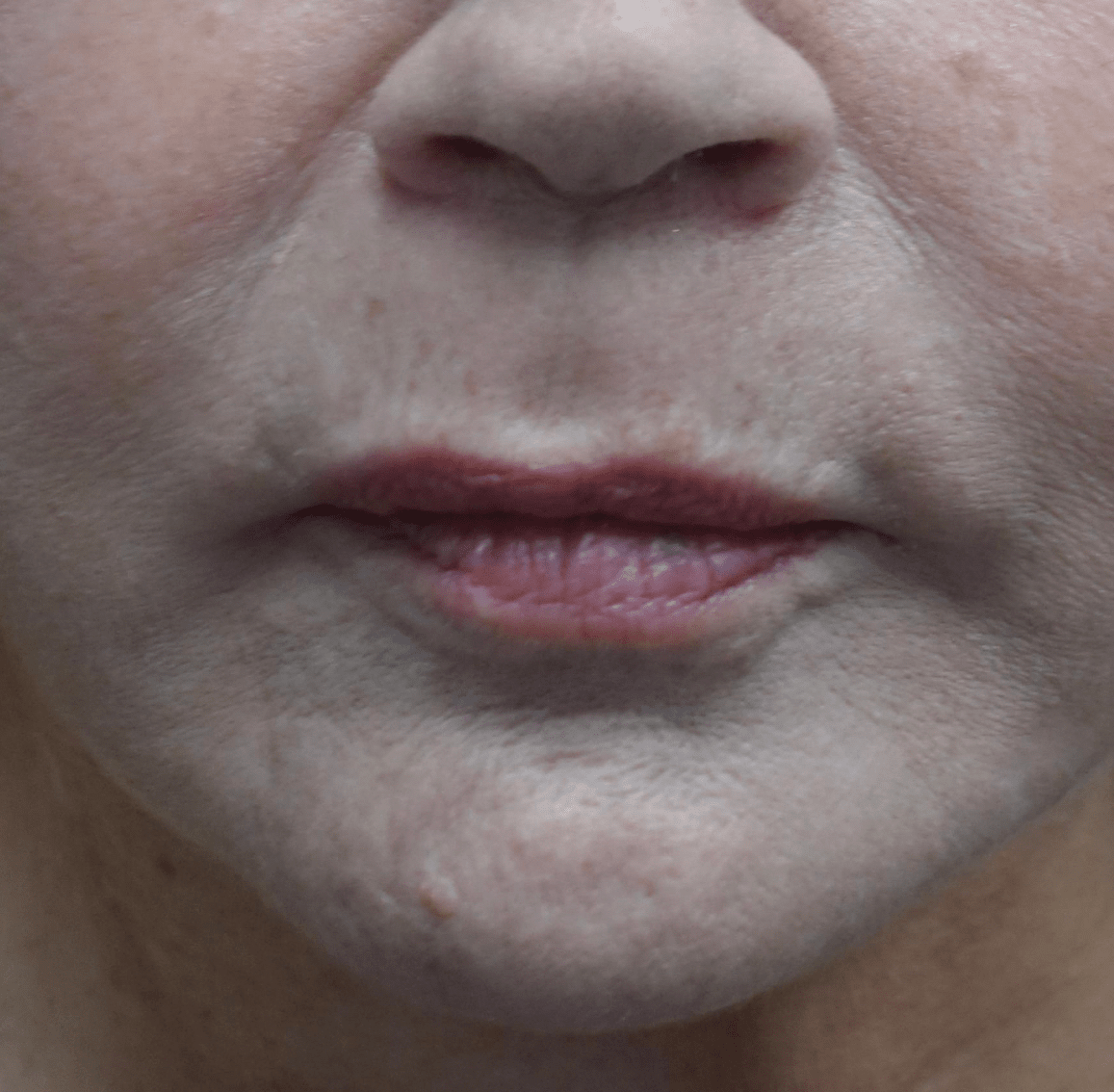 Fillers & Injectables Before & After Patient #19713
