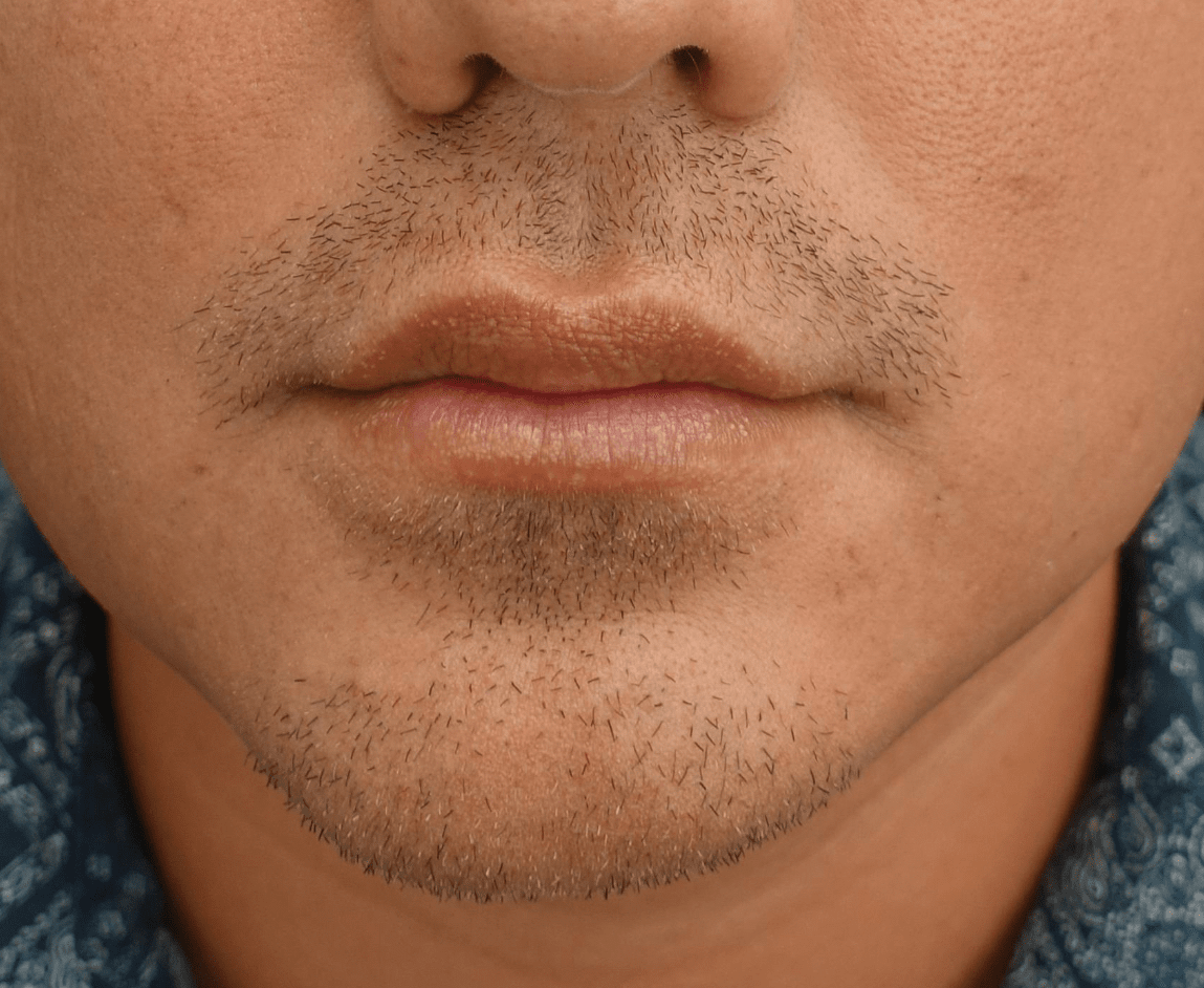 Fillers & Injectables Before & After Patient #19716