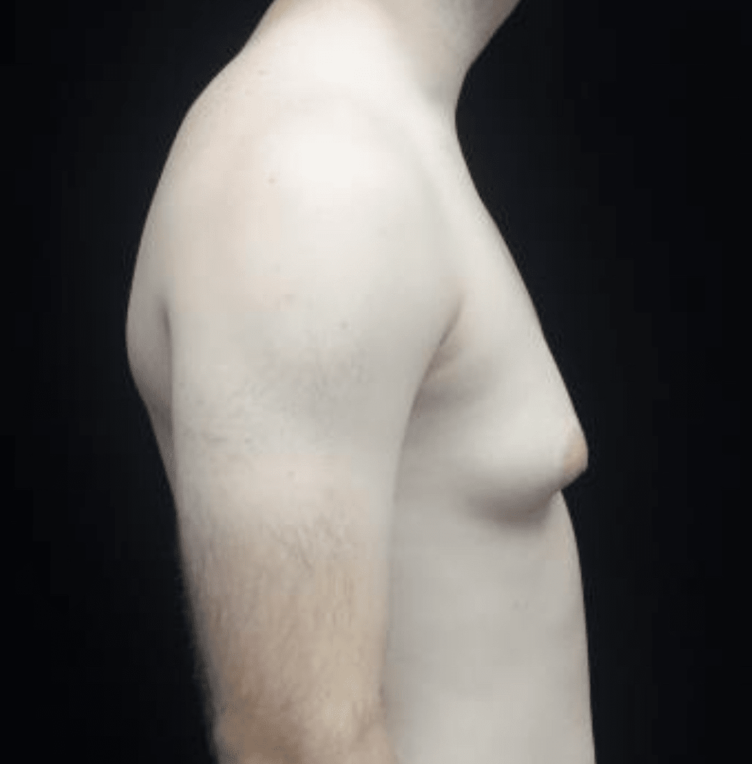 Gynecomastia Before & After Patient #19719