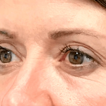 Blepharoplasty Before & After Patient #19726
