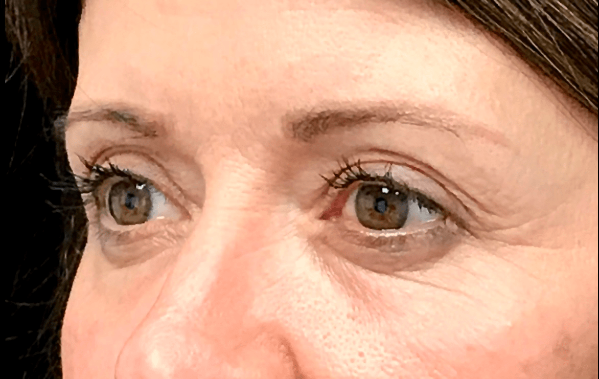 Blepharoplasty Before & After Patient #19726