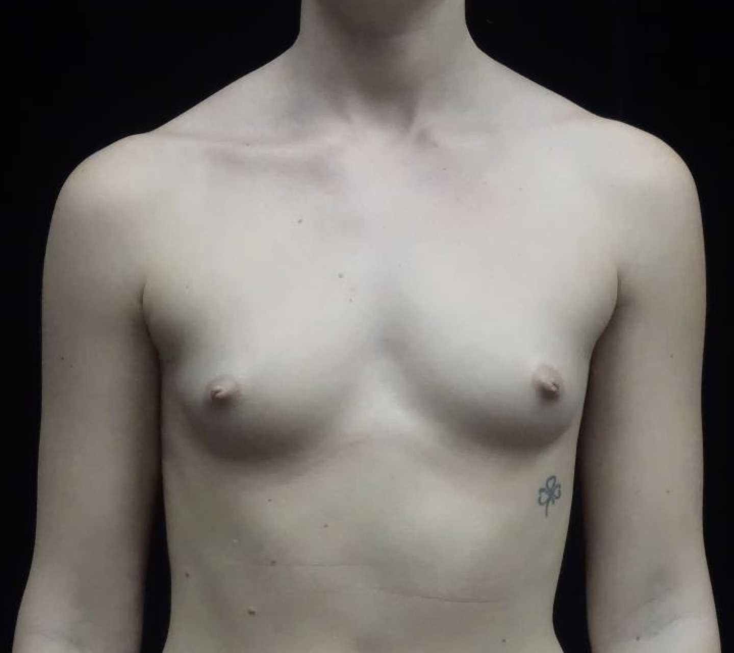 Breast Augmentation (Implants) Before & After Patient #19654