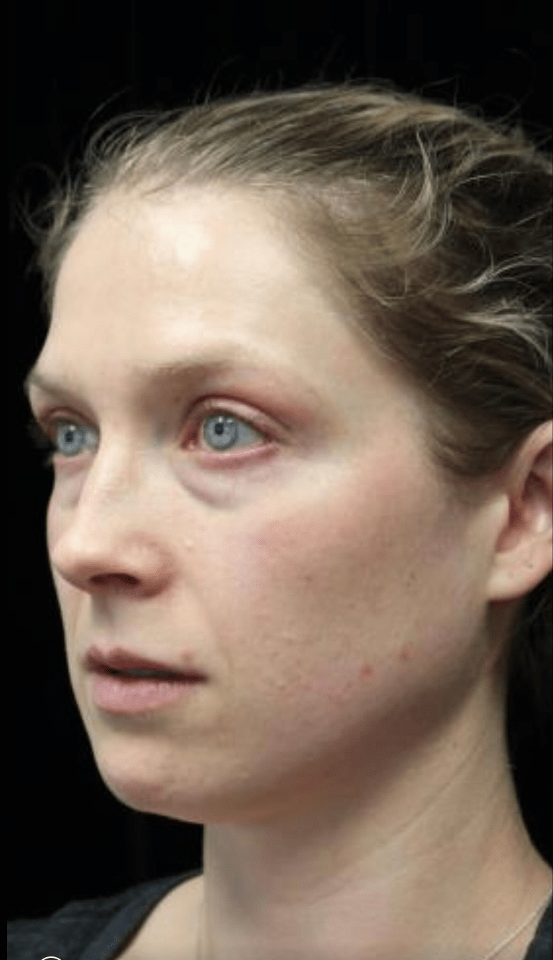 Chemical Peels Before & After Patient #19623