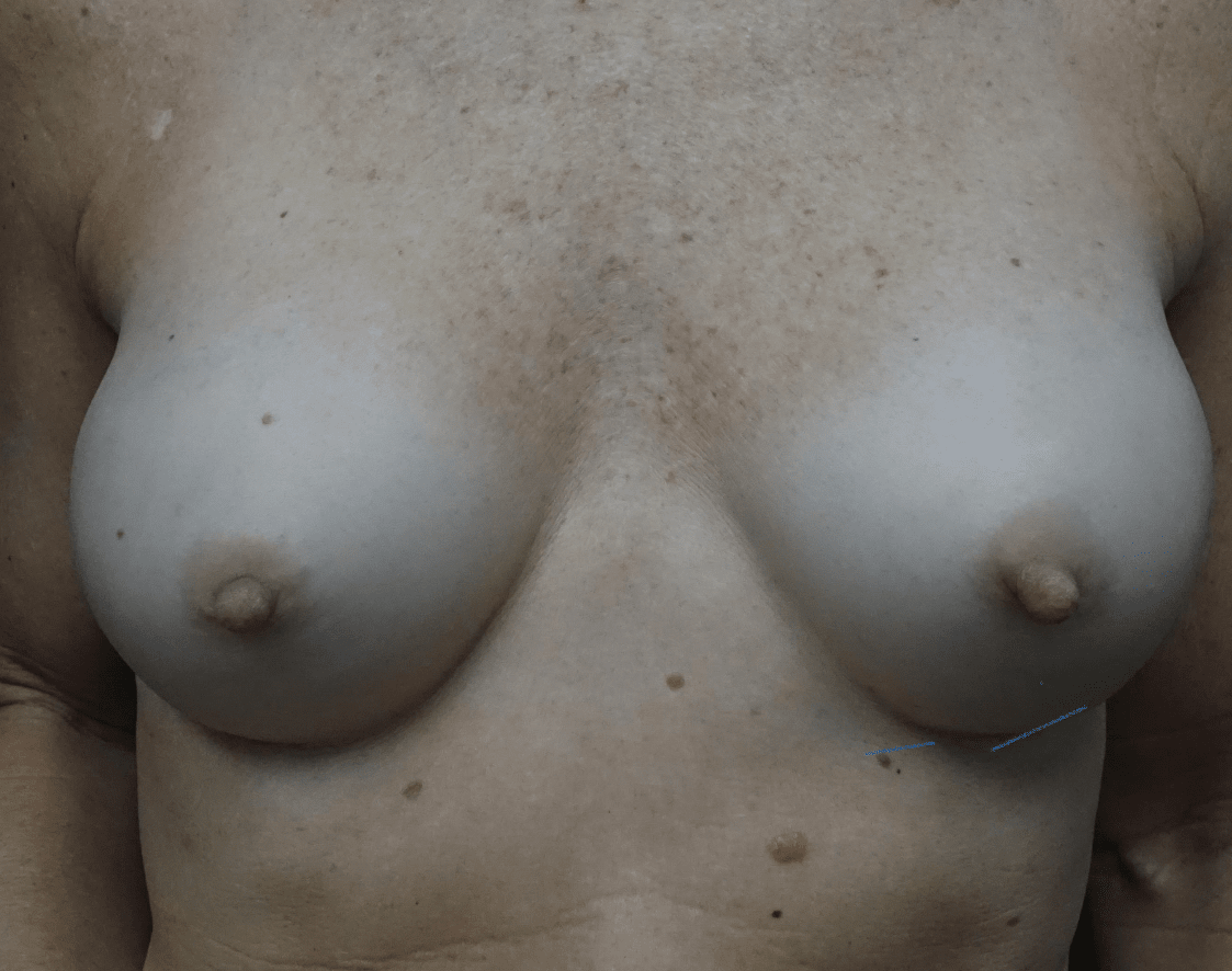 Nipple Inversion Before & After Patient #19740