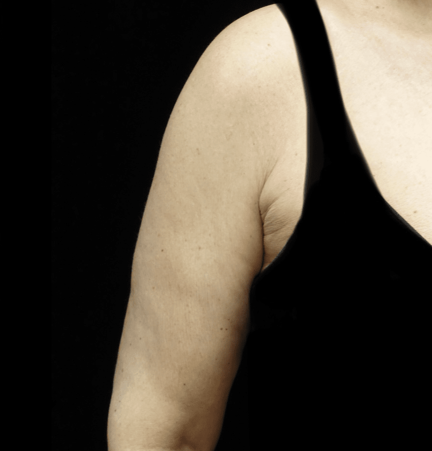 CoolSculpting Before & After Patient #19755