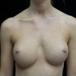 Breast Augmentation (Implants) Before & After Patient #19654