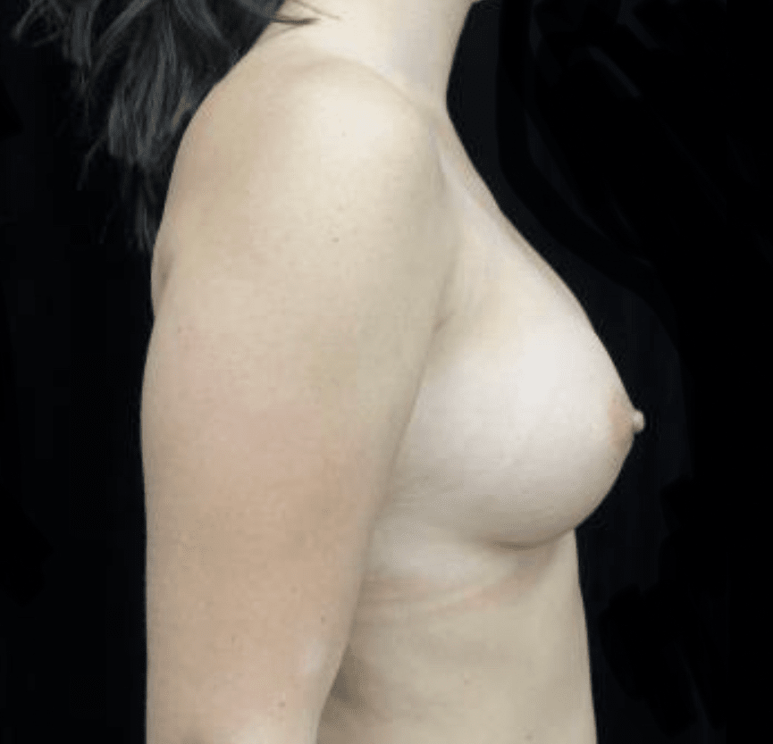 Breast Augmentation (Implants) Before & After Patient #19761