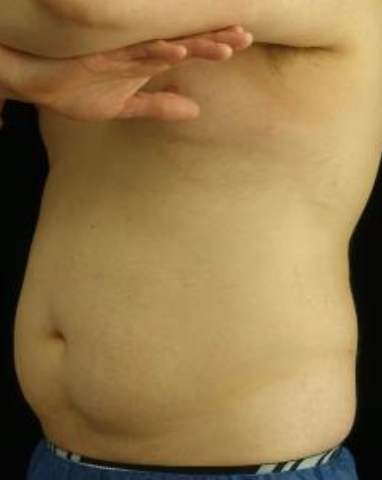 CoolSculpting Before & After Patient #19661