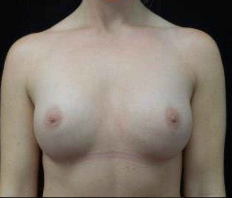 Breast Augmentation (Implants) Before & After Patient #19669