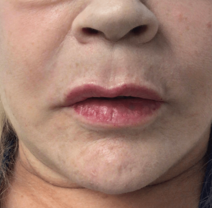 Lip Augmentation - Fillers Before & After Patient #19713