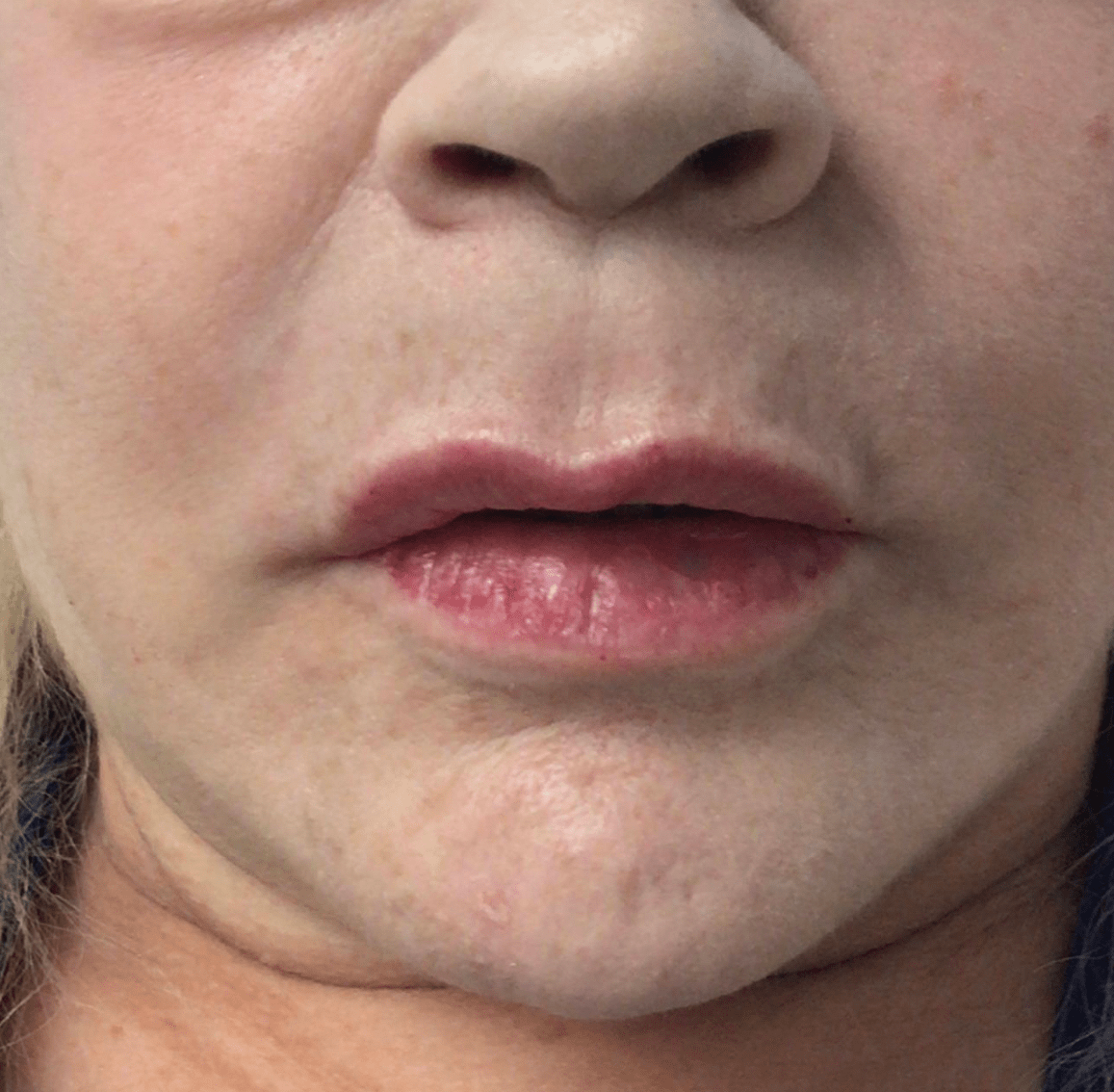 Fillers & Injectables Before & After Patient #19713