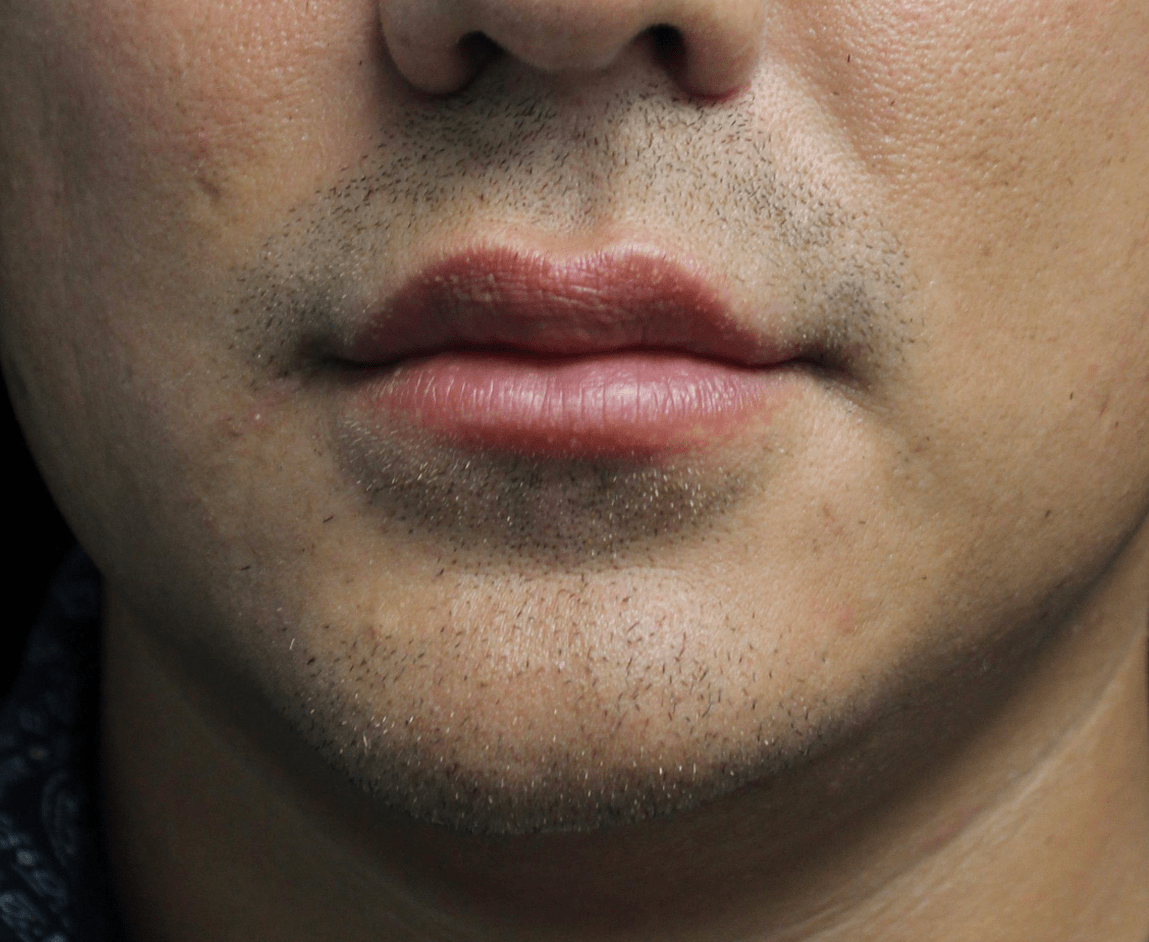 Fillers & Injectables Before & After Patient #19716