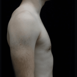 Gynecomastia Before & After Patient #19719