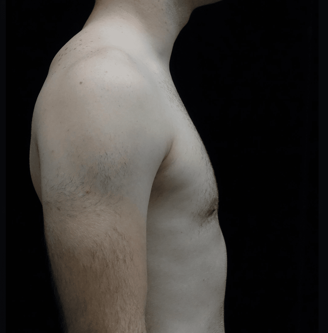 Gynecomastia Before & After Patient #19719