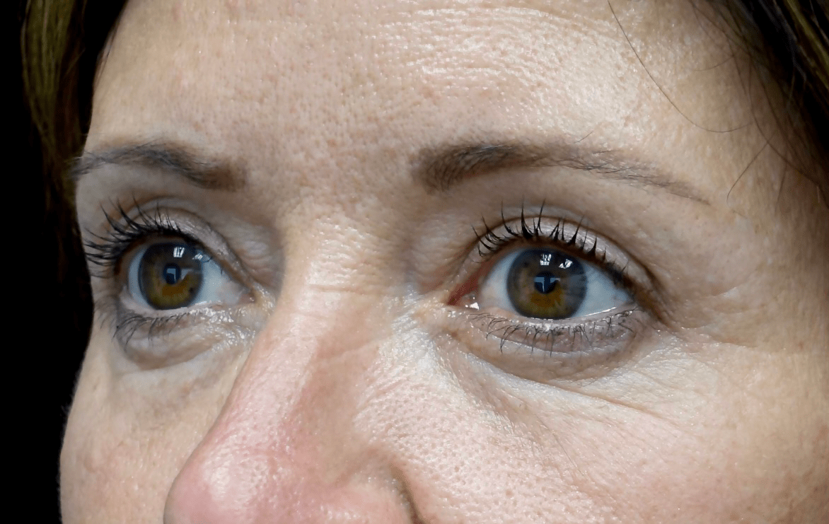 Blepharoplasty Before & After Patient #19726