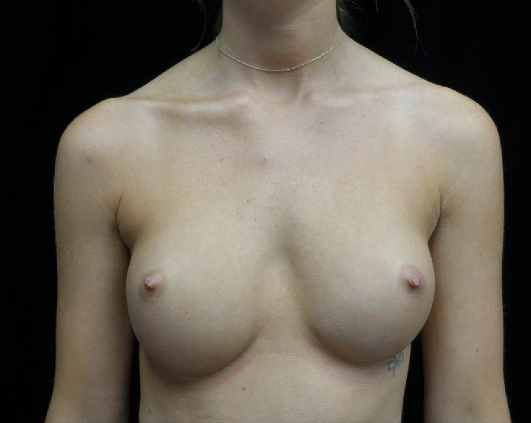 Breast Augmentation (Implants) Before & After Patient #19654
