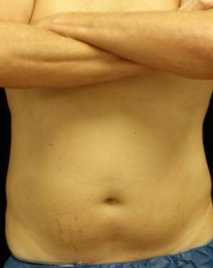 CoolSculpting Before & After Patient #19661