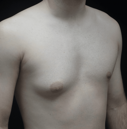 Gynecomastia Before & After Patient #19719
