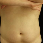 CoolSculpting Before & After Patient #19661
