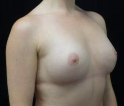 Breast Augmentation (Implants) Before & After Patient #19669