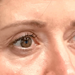 Blepharoplasty Before & After Patient #19726