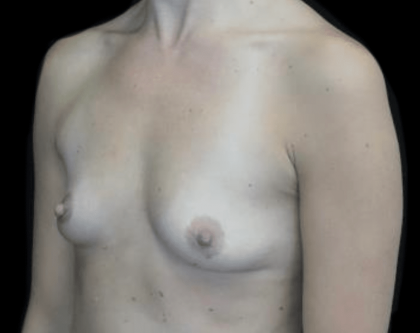 Breast Augmentation (Implants) Before & After Patient #19773