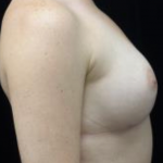 Breast Augmentation (Implants) Before & After Patient #19669