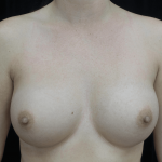 Breast Augmentation (Implants) Before & After Patient #19761