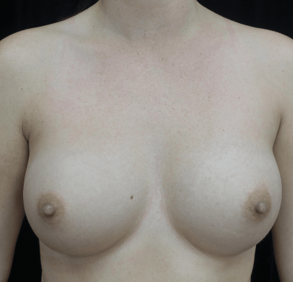 Breast Augmentation (Implants) Before & After Patient #19761