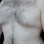 Gynecomastia Before & After Patient #19795