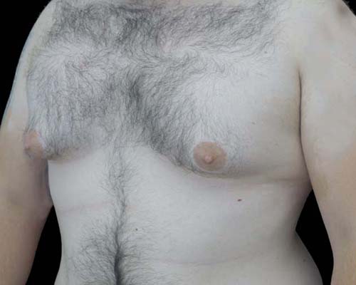 Gynecomastia Before & After Patient #19795