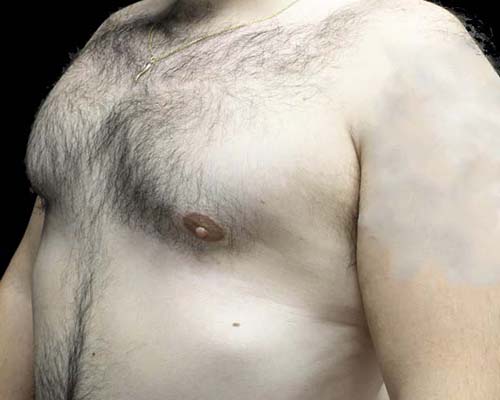 Gynecomastia Before & After Patient #19795