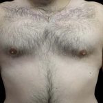 Gynecomastia Before & After Patient #19795