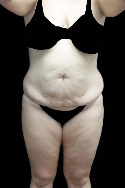 Liposuction Before & After Patient #19609