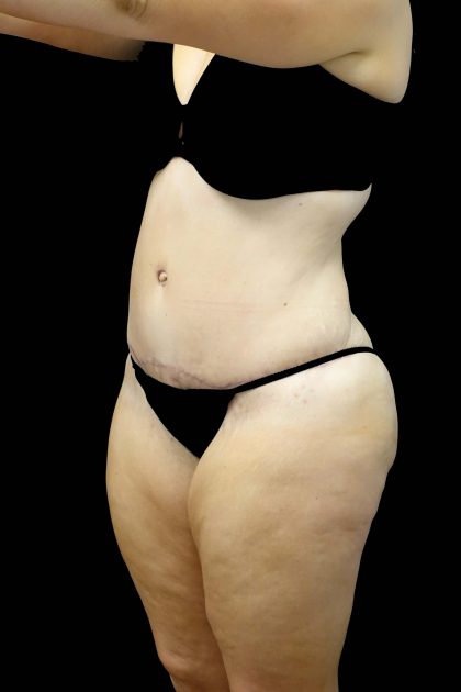 Liposuction Before & After Patient #19609