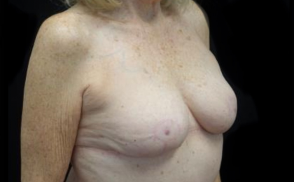 Breast Reduction Before & After Patient #19828